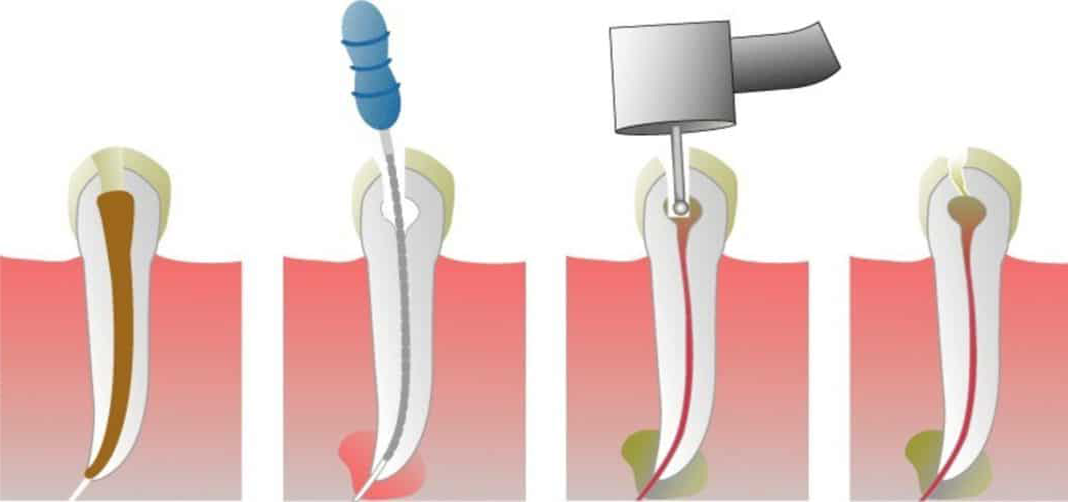 D Vitaliser Une Dent Explication Par Tape