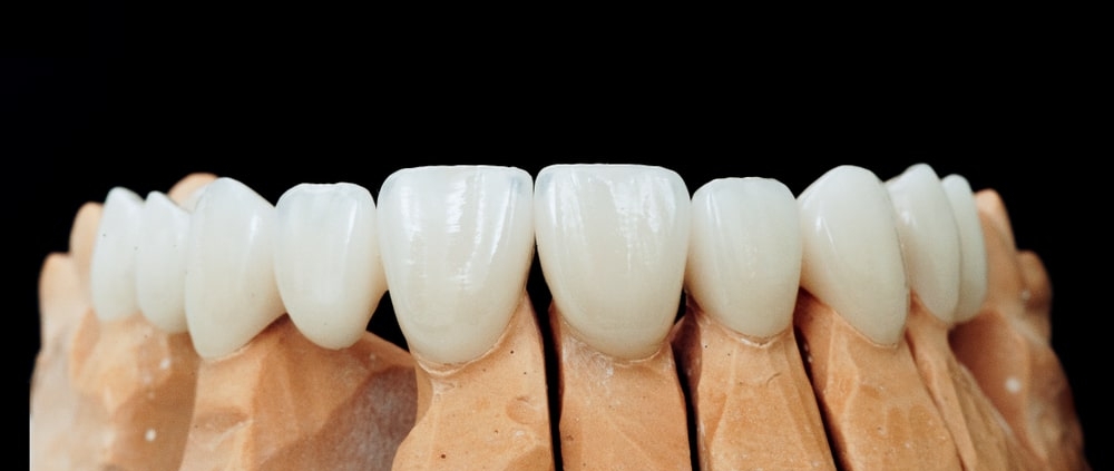 Prothèse dentaire amovible : quelle différence avec la prothèse fixe