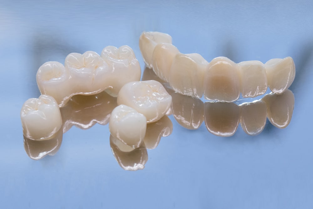 Les différences entre appareil dentaire provisoire et définitif