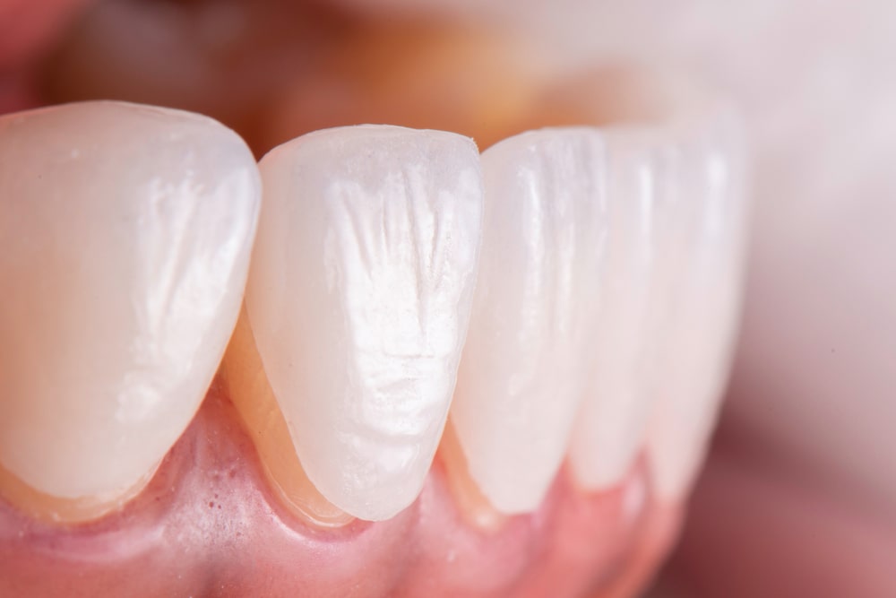 Les différences entre appareil dentaire provisoire et définitif