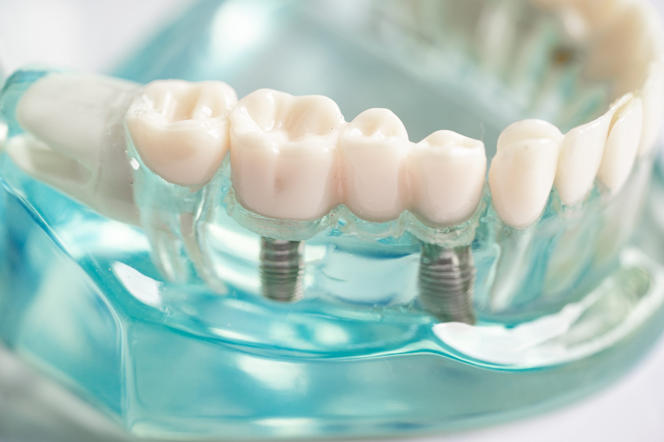 Implant dentaire titane: les avantages