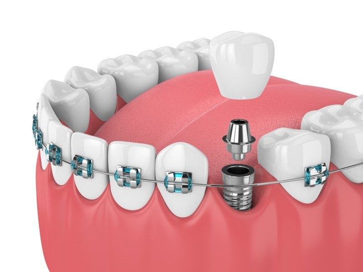 Protège-dents Dents Avec Bagues Transparentes Alignement Des Dents Par  Gouttières Dentisterie Orthodontique