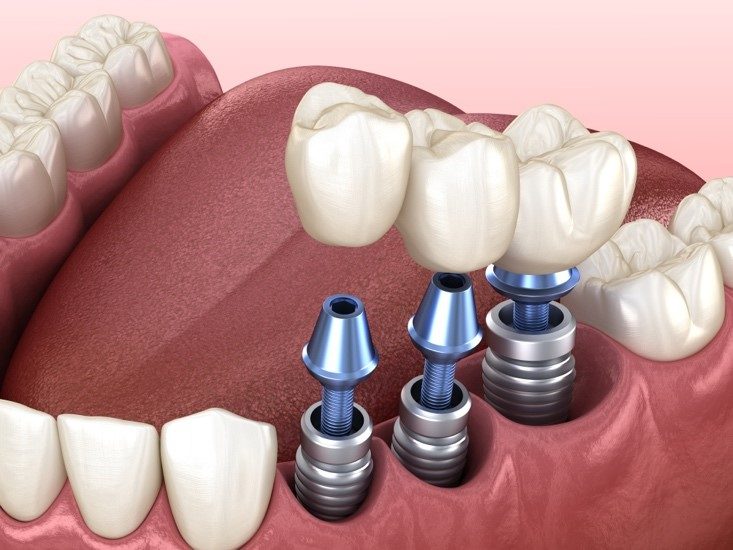 Meilleure colle pour appareil dentaire : Comparatif et Prix