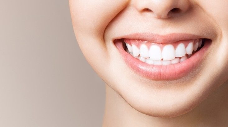 Mettre des facettes dentaires : comment se déroule la pose ?